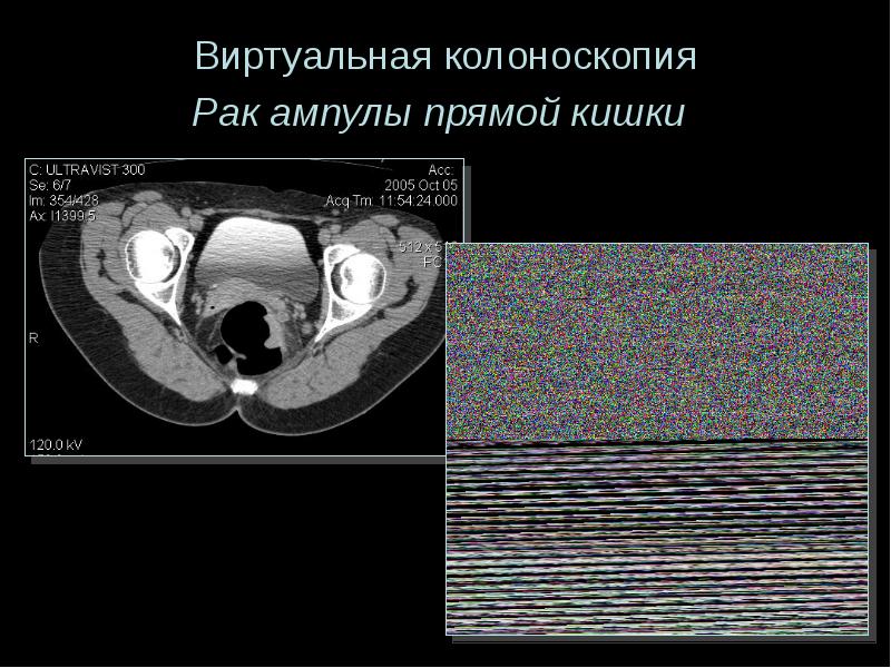 Виртуальная колоноскопия. Опухоль ампулы прямой кишки. Виртуальная колоноскопия на МСКТ. Опухоль прямой кишки колоноскопия. Ампула прямой кишки на кт.