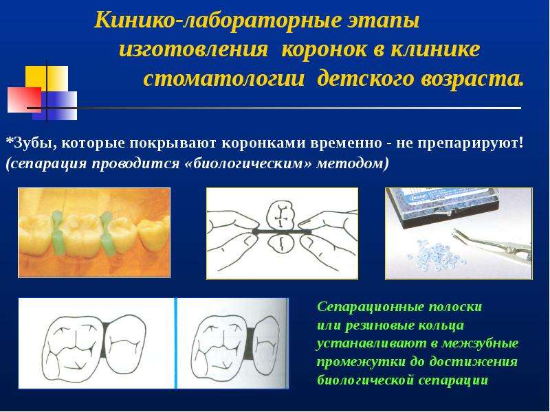 Этапы изготовления. Детское зубное протезирование презентация. Клиника лабораторная этапы изготовления искусственных коронок. Этапы изготовления временных коронок лабораторно. Этапы изготовления временной коронки прямым способом.