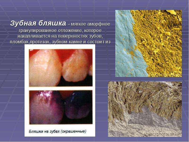 Зубная бляшка - мягкое аморфное гранулированное отложение, которое накапливается на поверхностях зуб