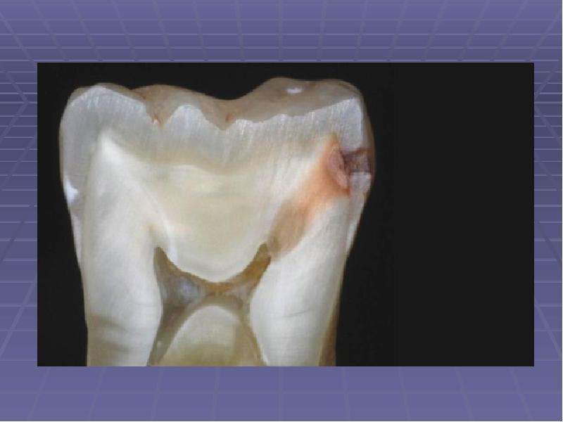 Особенности течения кариеса во временных зубах, слайд 32