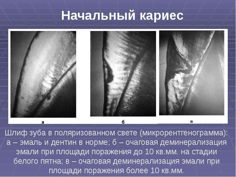 Особенности течения кариеса во временных зубах, слайд 34