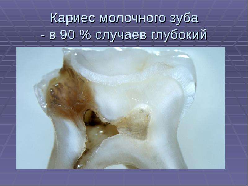 Кариес молочного зуба - в 90 % случаев глубокий