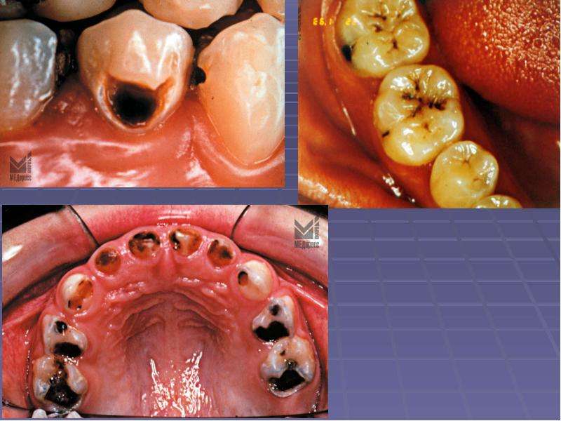 Особенности течения кариеса во временных зубах, слайд 39