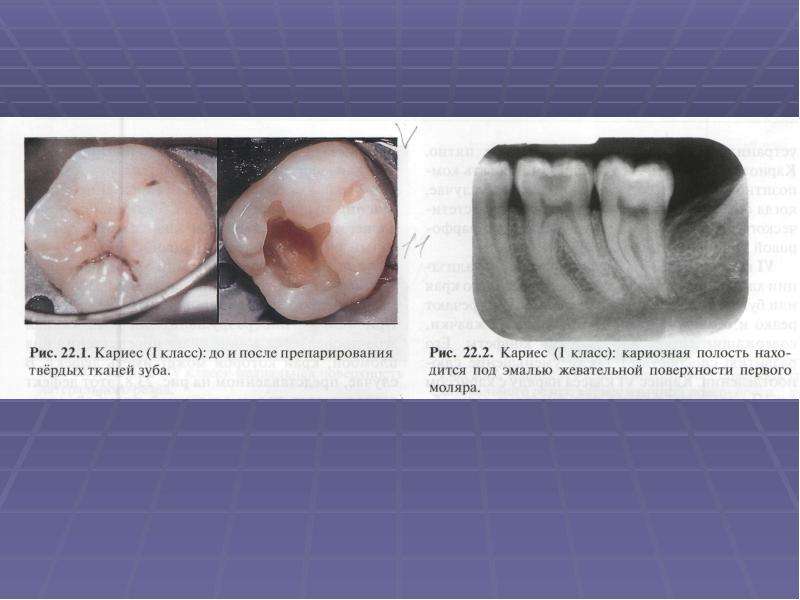 Особенности течения кариеса во временных зубах, слайд 40