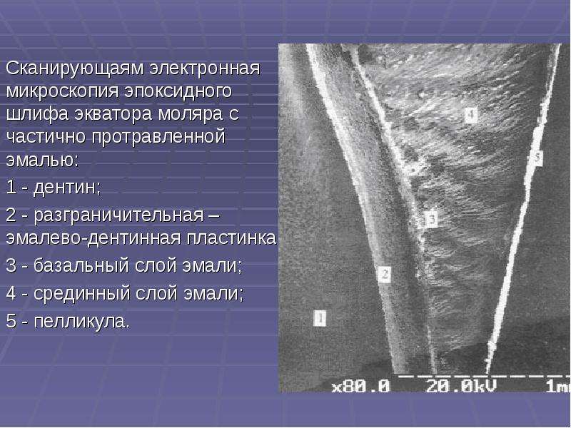 Сканирующаям электронная микроскопия эпоксидного шлифа экватора моляра с частично протравленной эмал