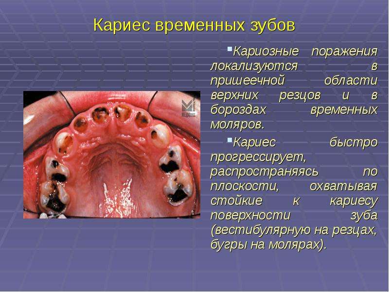 Кариес временных зубов Кариозные поражения локализуются в пришеечной области верхних резцов и в боро