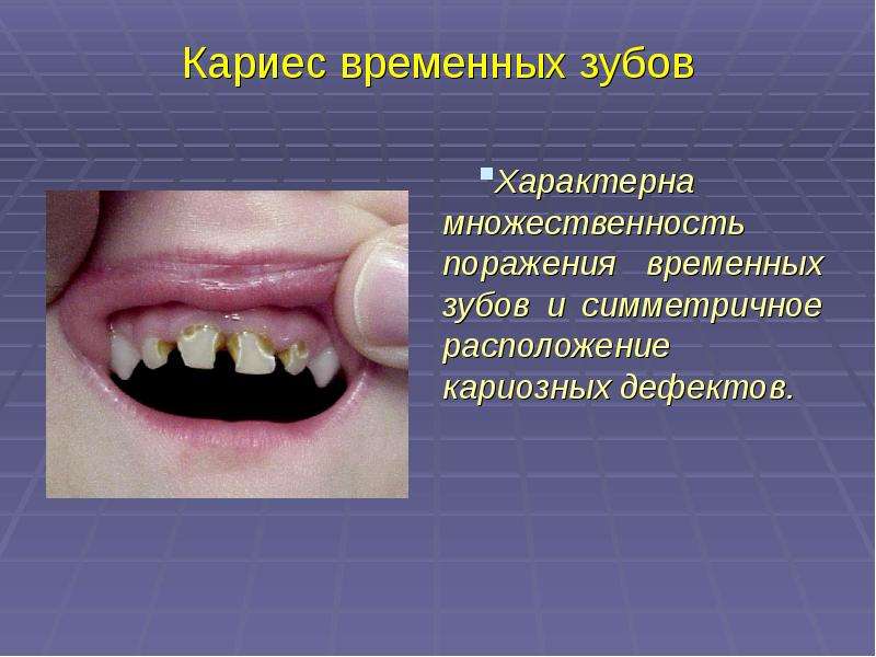 Кариес временных зубов Характерна множественность поражения временных зубов и симметричное расположе