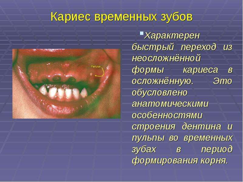 Кариес временных зубов Характерен быстрый переход из неосложнённой формы кариеса в осложнённую. Это