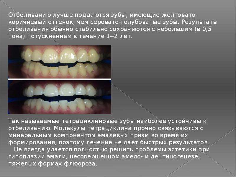 реферат по отбеливанию зубов