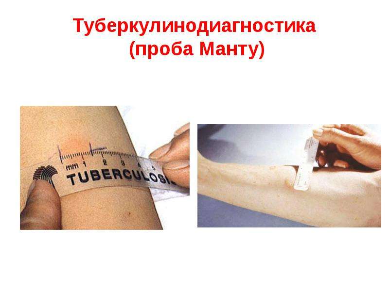 Манту и диаскинтест результаты фото