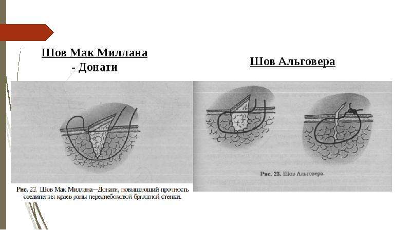 Шов донати схема