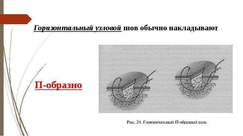 Виды швов хирургия фото