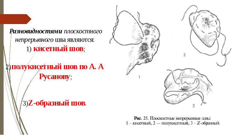 Виды швов хирургия фото