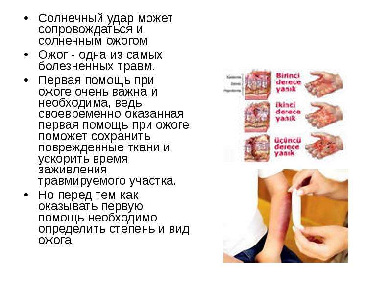   Солнечный удар может сопровождаться и солнечным ожогом
Солнечный удар может сопровождаться и солнечным ожогом
Ожог - одна из самых болезненных травм.
Первая помощь при ожоге очень важна и необходима, ведь своевременно оказанная первая помощь при ожоге поможет сохранить поврежденные ткани и ускорить время заживления травмируемого участка.
Но перед тем как оказывать первую помощь необходимо определить степень и вид ожога. 
