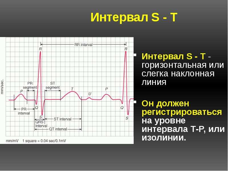 Дрейф изолинии на экг что это