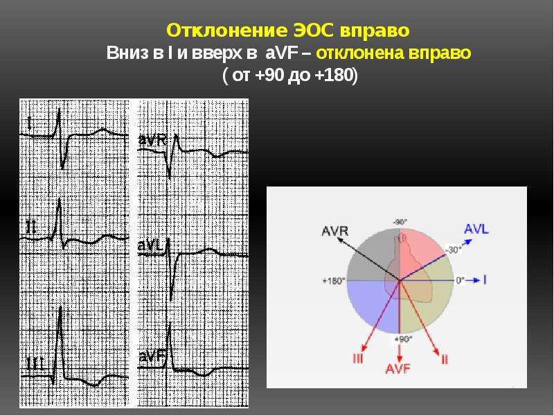 Экг электрическая ось вправо