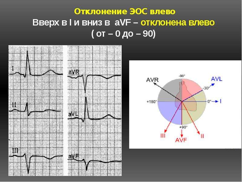 Отклонения на экг. ECG электрическая ось влево. ЭКГ ритм синусовый отклонение ЭОС. Отклонение оси сердца на ЭКГ. Откл ЭОС влево ЭКГ.