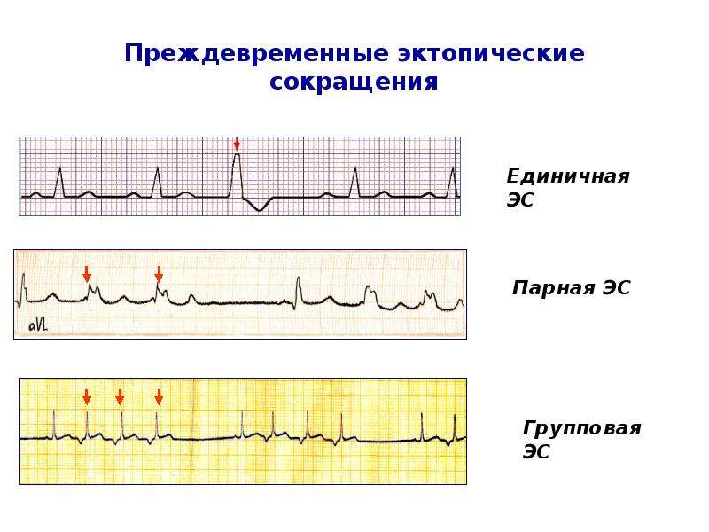 Эктопический это