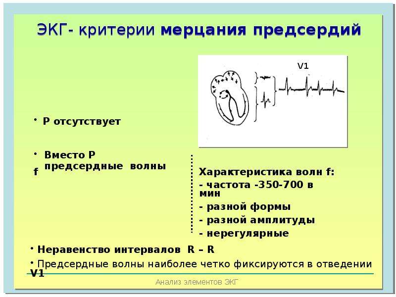 Отсутствие р на экг. Критерии ЭКГ. Основы электрокардиографии. ЭКГ для врача общей практики. Предсердные волны f на ЭКГ.