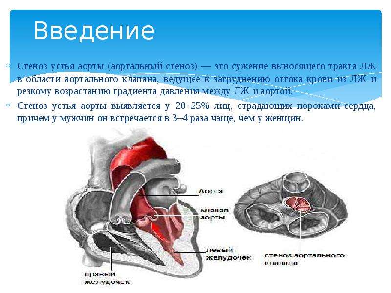 Аортальный стеноз презентация