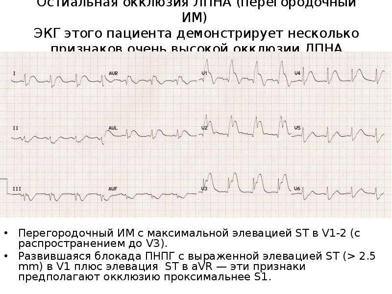 Изменение миокарда перегородочной области. Инфаркт ЭКГ элевация St. Элевация St в v1. ЭКГ передне перегородочный инфаркт. Элевация сегмента St на ЭКГ.