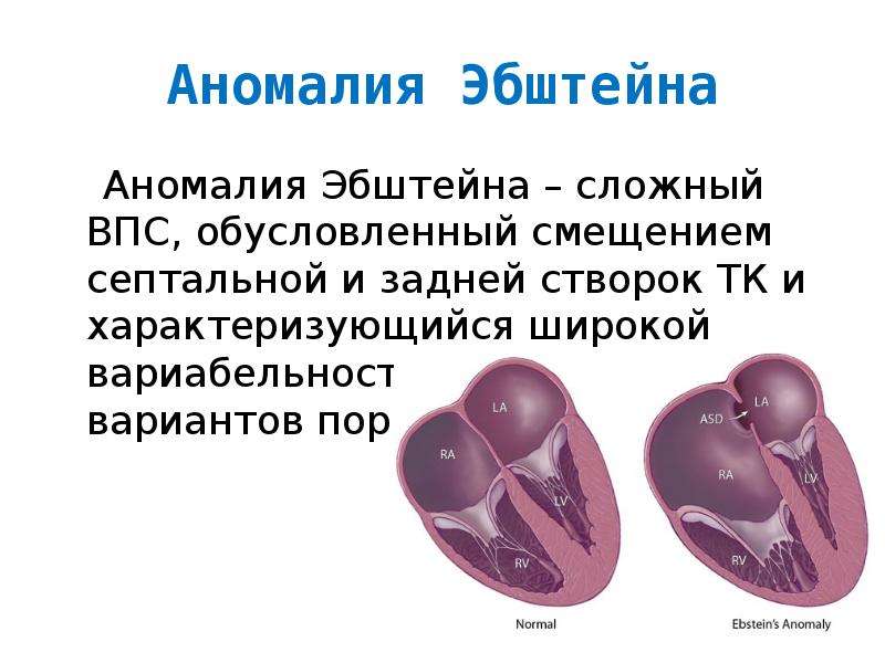 Аномалии эбштейна презентация