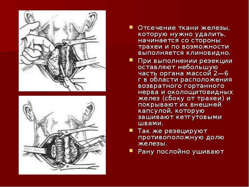 Загрудинная трахеостомия. Этапы трахеостомии топографическая анатомия. Трахеостомия по Бьерку.