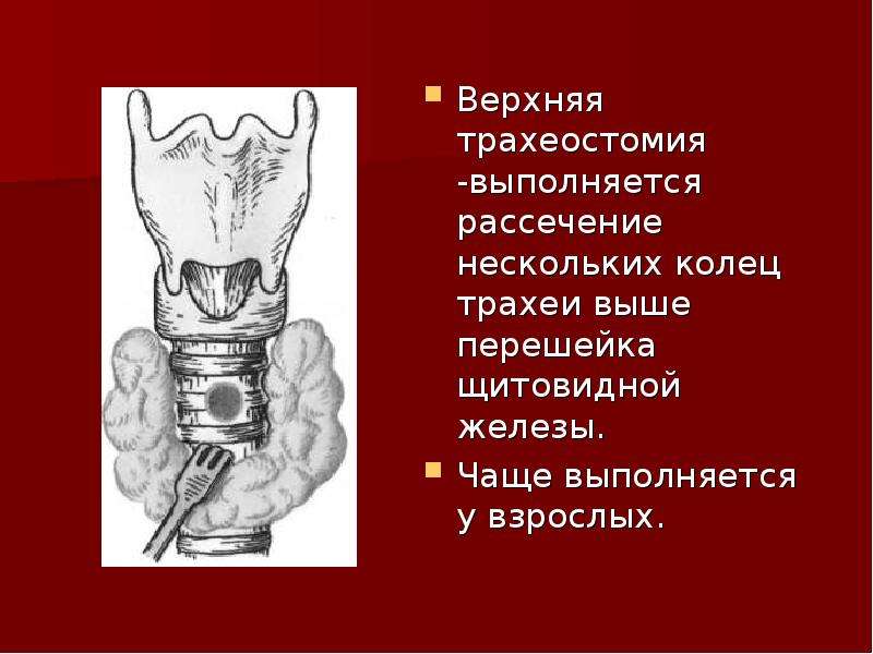 Наложение трахеостомы. Трахеотомия и трахеостомия. Продольная и поперечная трахеостомия. Верхняя и нижняя трахеостомия топографическая анатомия. Щитовидная железа трахеостомия.