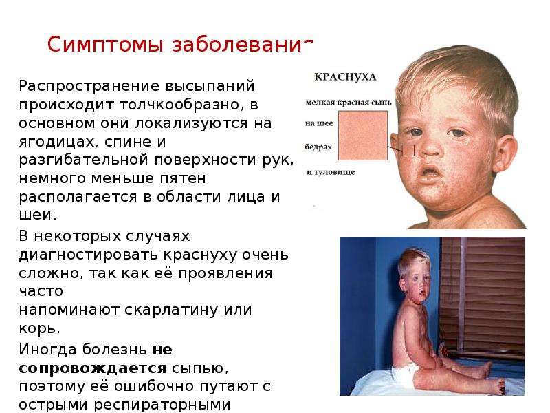 Бесплатные презентации на тему краснуха скачать бесплатно