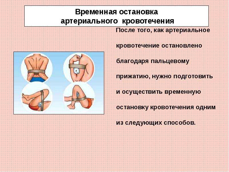 Приемы остановки артериального кровотечения