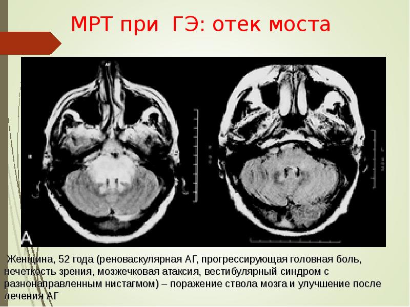 Мрт 11. Мрт при синдроме Туретта.