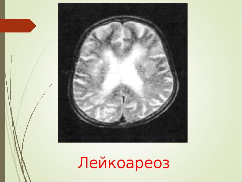 Лейкоареоз головного. Лейкоареоз. Лейкоареоза что это такое. Лейкоареоз на кт. Степени лейкоареоза.