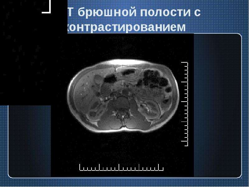 Что лучше узи или мрт брюшной полости. Мрт брюшной полости заключение.