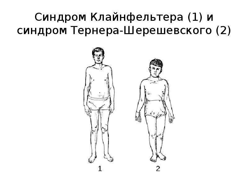 Синдром клайнфельтера фото. Синдром Клайнфельтера неврология. Синдром Кляйн Фельтера. Тип наследования Клайнфельтера. Синдром Клайнфельтера симптомы.