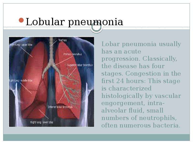 Lobar pneumonia usually has an acute progression. Classically, the disease has four stages. Congesti