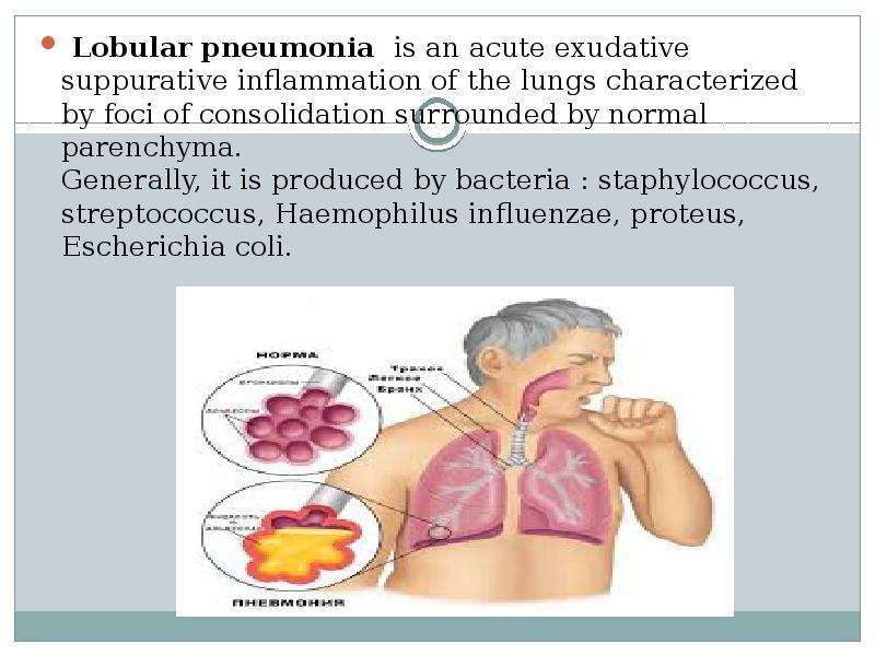 Lobular pneumonia is an acute exudative suppurative inflammation of the lungs characterized by foci