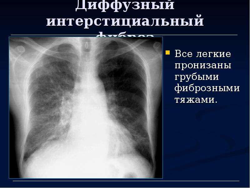 Фиброз нижних долей легких. Пневмофиброз лёгких на рентгене. Фиброзные тяжи в легких рентген.