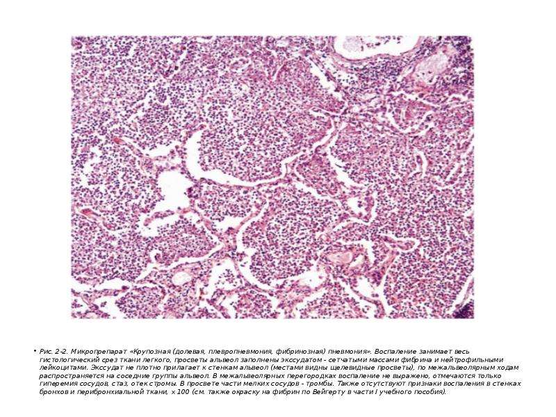 Пневмония микропрепарат описание. Бронхопневмония гистология. Фибринозная пневмония гистология. Бронхопневмония микропрепарат патанатомия. Гриппозная пневмония гистология.