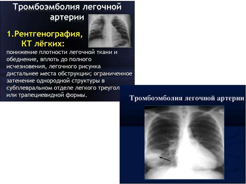 Обеднение легочного рисунка