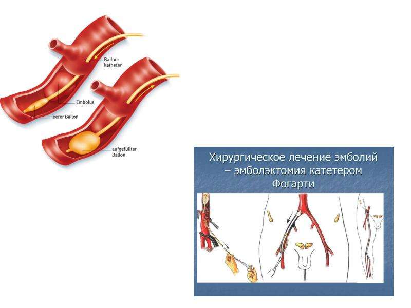 Тромбоз артерии лечение. Эмболии и тромбозы магистральных артерий конечностей. Тромбоз и тромбоэмболия магистральных артерий конечностей клиника. Острый тромбоз Магистральной артерии конечности. Острый тромбоз магистральных артерий классификация.