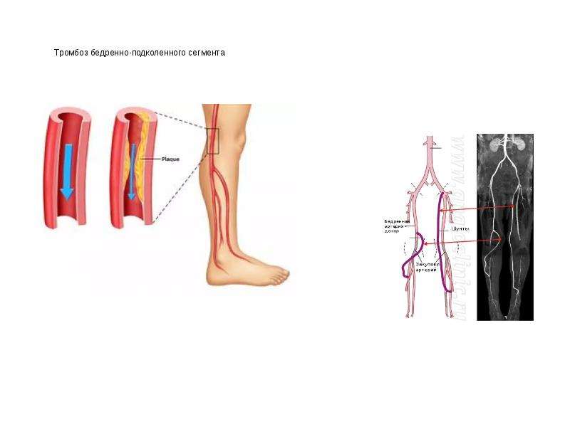 Тромбоз артерия и вена. Клиника эмболии подколенной артерии. Тромбоз малоберцовой артерии. Артериальный тромбоз сосудов нижних конечностей. Тромбоз и эмболия сосудов нижней конечности.