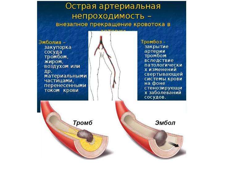 Звонкий сосуд. Острые тромбозы и эмболии магистральных артерий. Клиника острого тромбоза артерий нижних конечностей. Тромбоз и эмболия магистральных артерий. Острый тромбоз магистральных артерий.