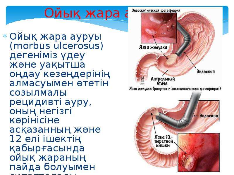 Созылмалы холецистит презентация