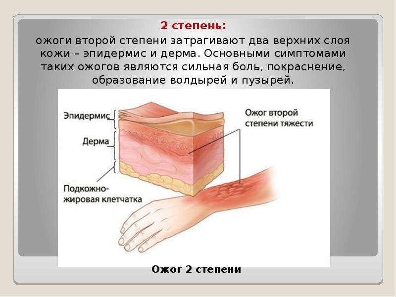 Первая помощь при ожогах презентация скачать бесплатно