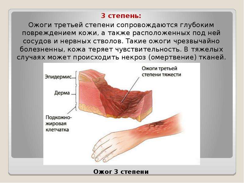 Первая помощь при ожогах презентация скачать бесплатно