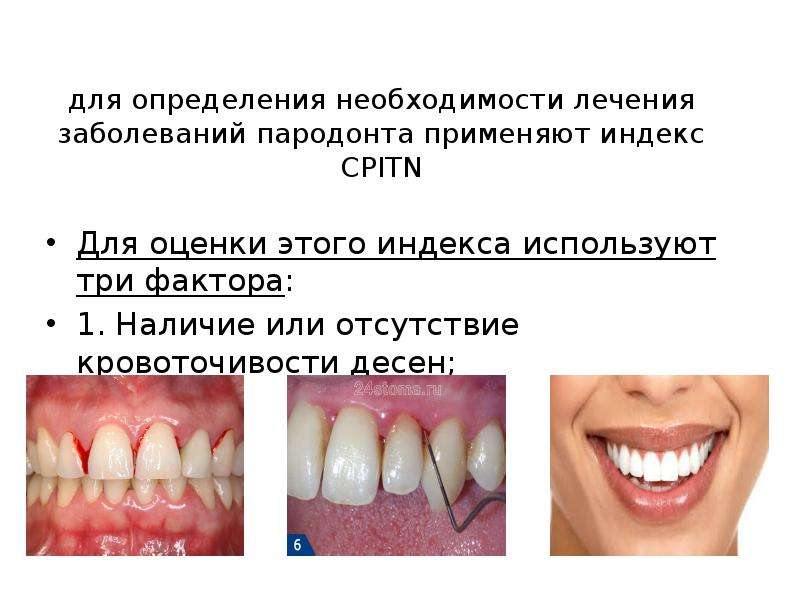 Оценка пародонта. CPITN расшифровка. Индекс кровоточивости десны. Индекс CPITN В стоматологии. Оценка CPITN индекса.