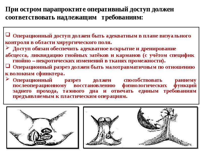 Острый парапроктит карта вызова смп