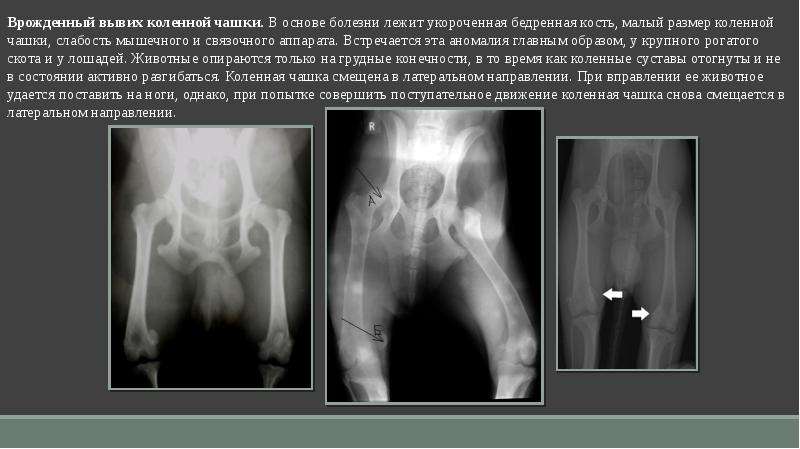 Врожденные вывихи бедра презентация