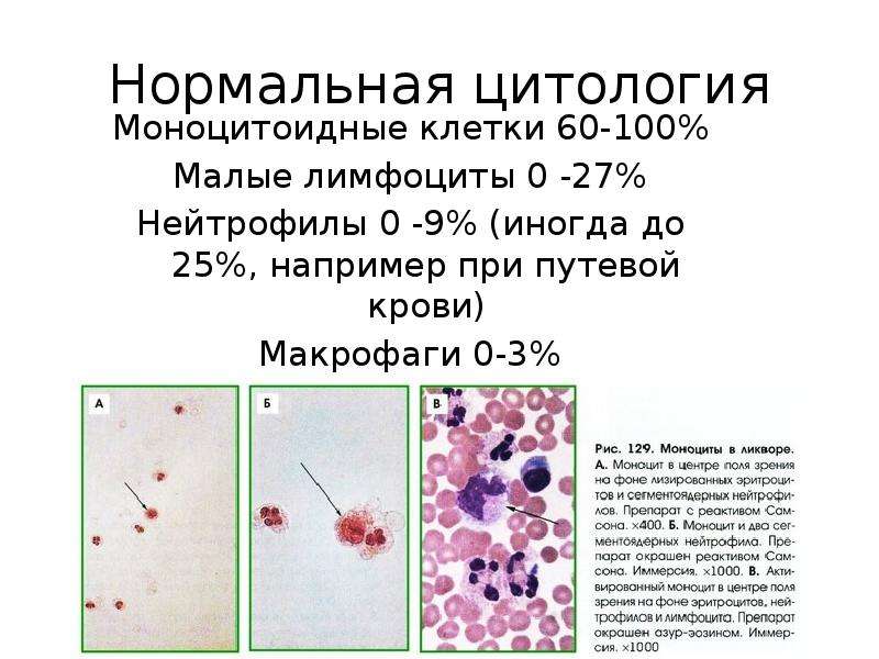 Цитология клетки. Дегенеративные нейтрофилы в цитологии. Нейтрофилы микроскопия цитология. Клетки крови цитология.