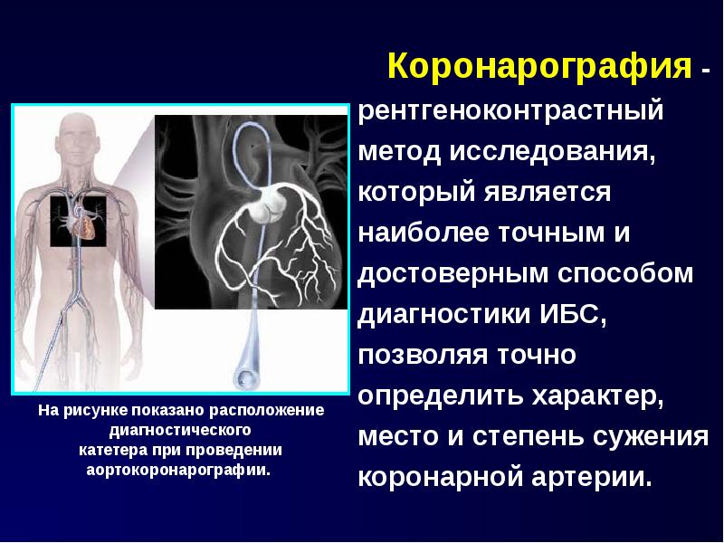 Коронарография - рентгеноконтрастный метод исследования, который является наиболее точным и достовер